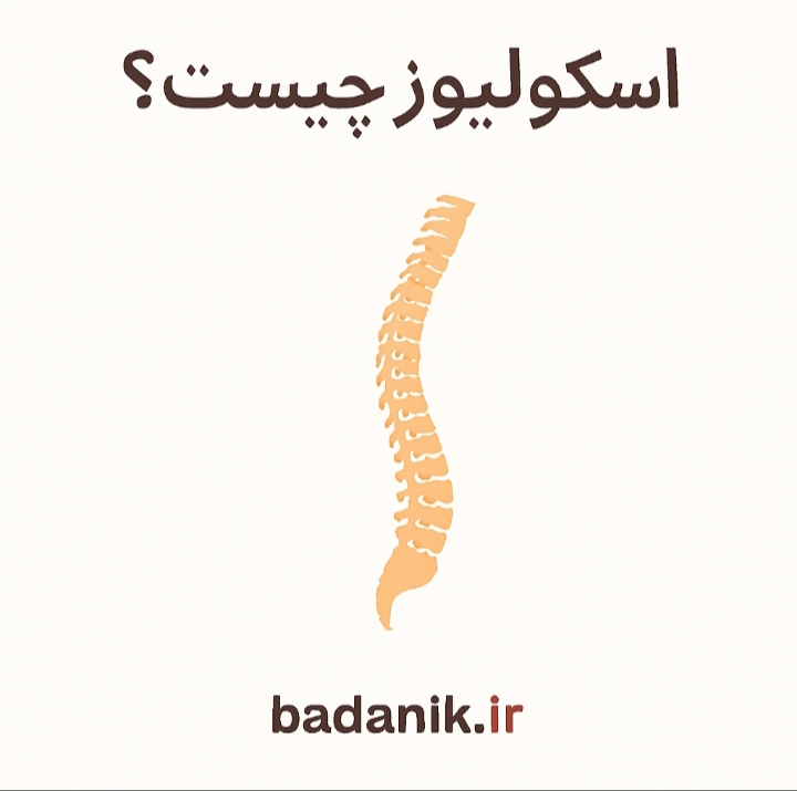 اسکولیوز